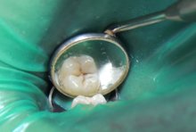 Пломбирование жевательного зуба при лечении кариеса