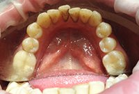 Чистка бактериального налета на зубах