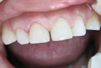 Реставрация режущего края передних зубов