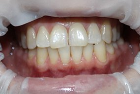 Устранение дисколорита зубов методом ZOOM