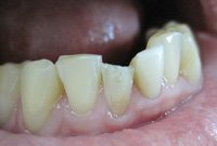 Устранение скола на переднем зубе