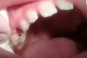 Лечение кариеса молочного зуба после удаления соседнего