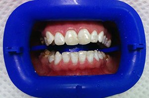 Осветление зубной эмали профессиональной системой ZOOM
