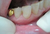 Лечение кариеса корня зуба