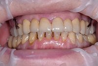 Восстановление зубов металлокерамикой и бюгельным протезом