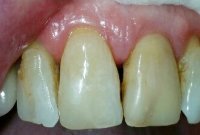 Реставрация зуба пломбировочным материалом Estelite