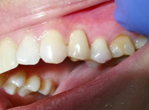 Трансдентальное шинирование при отсутствующем зубе
