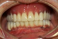 Тотальное протезирование зубов на имплантах