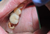 Установка вкладки при реставрации разрушенного зуба