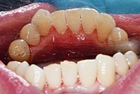 Снятие твердых зубных отложений ультразвуком