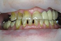 Восстановление зубов металлокерамикой и бюгельным протезом