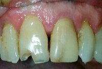 Реставрация зуба пломбировочным материалом Estelite