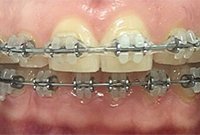 Лечение диастемы керамической брекет-системой