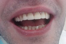 Протезирование передних зубов металлокерамикой