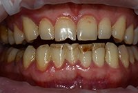 Лечение дисколорита зубов — профессиональная чистка