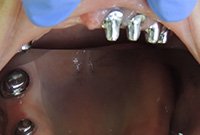 Протезирование верхнего зубного ряда телескопическими коронками