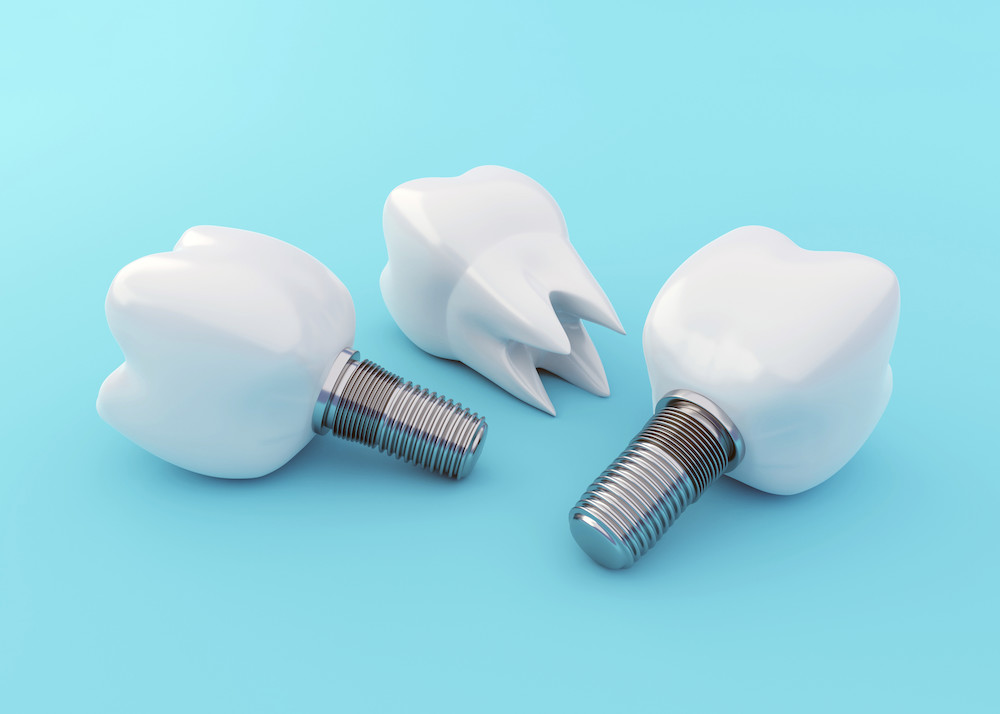Импланты A.B. Dental: 2 по цене 1