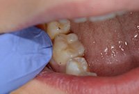 Лечение кариеса жевательного зуба пломбировочным материалом