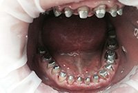 Металлокерамические коронки при патологической стираемости зубов