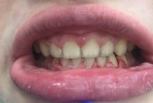 Исправление неправильного постоянного прикуса зубов