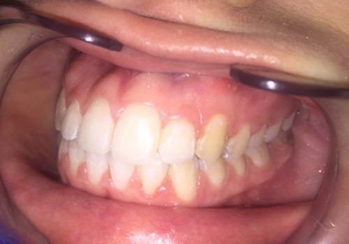 Выравнивание зубов комбинированными брекетами Ormco