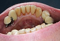 Профилактика заболеваний пародонта — снятие зубных отложений