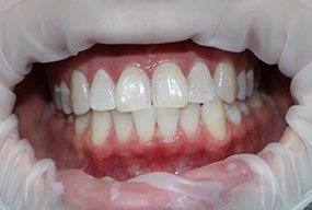 Устранение дисколорита зубов методом ZOOM
