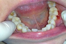 Протезирование жевательных зубов металлокерамическими коронками