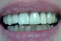 Коррекция зубных дефектов в зоне улыбки винирами