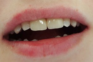 Реставрация сколов передних зубов