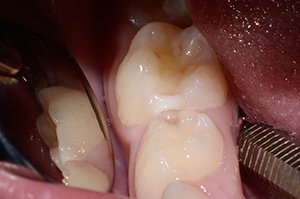 Лечение кариеса зубов у ребенка