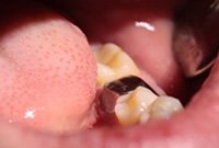 Восстановление жевательного зуба металлокерамической коронкой