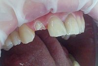 Восстановление зуба коронкой из диоксида циркония
