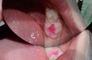 Пломбирование детского зуба при лечении кариеса