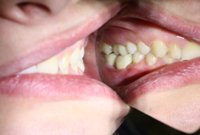 Протезирование моляров зубными коронками на имплантах