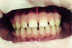 Исправление неправильного постоянного прикуса зубов