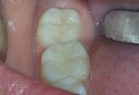 Реставрация жевательных зубов материалом Filtek Ultimate