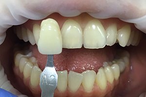 Отбеливание зубов оттенка А2