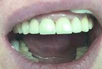 Несъемное протезирование передних зубов металлокерамикой