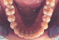 Лечение скученности зубов брекетами