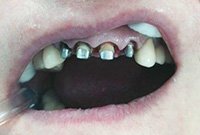 Несъемное протезирование передних зубов металлокерамикой