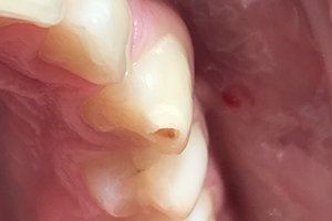 Лечение детского кариеса коренного зуба материалом Эстелайт