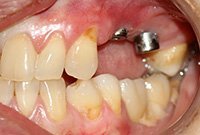 Восстановление зубов коронками на имплантах