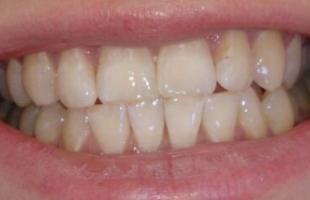 Профессиональное отбеливание зубов по технологии ZOOM