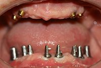 Тотальное протезирование зубов на имплантах