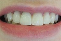 Установка виниров на зубы с флюорозом