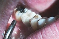 Несъемное протезирование жевательного зуба коронкой на импланте