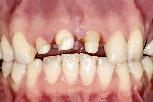 Протезирование фронтальных зубов коронками на имплантах