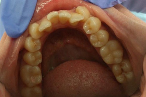 Выравнивание зубов на нижней челюсти брекетами Damon Q
