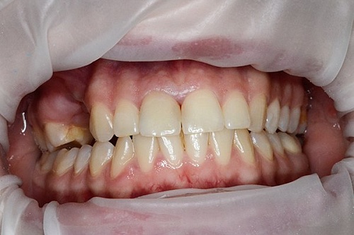 Выравнивание верхнего зубного ряда брекетами Damon Clear